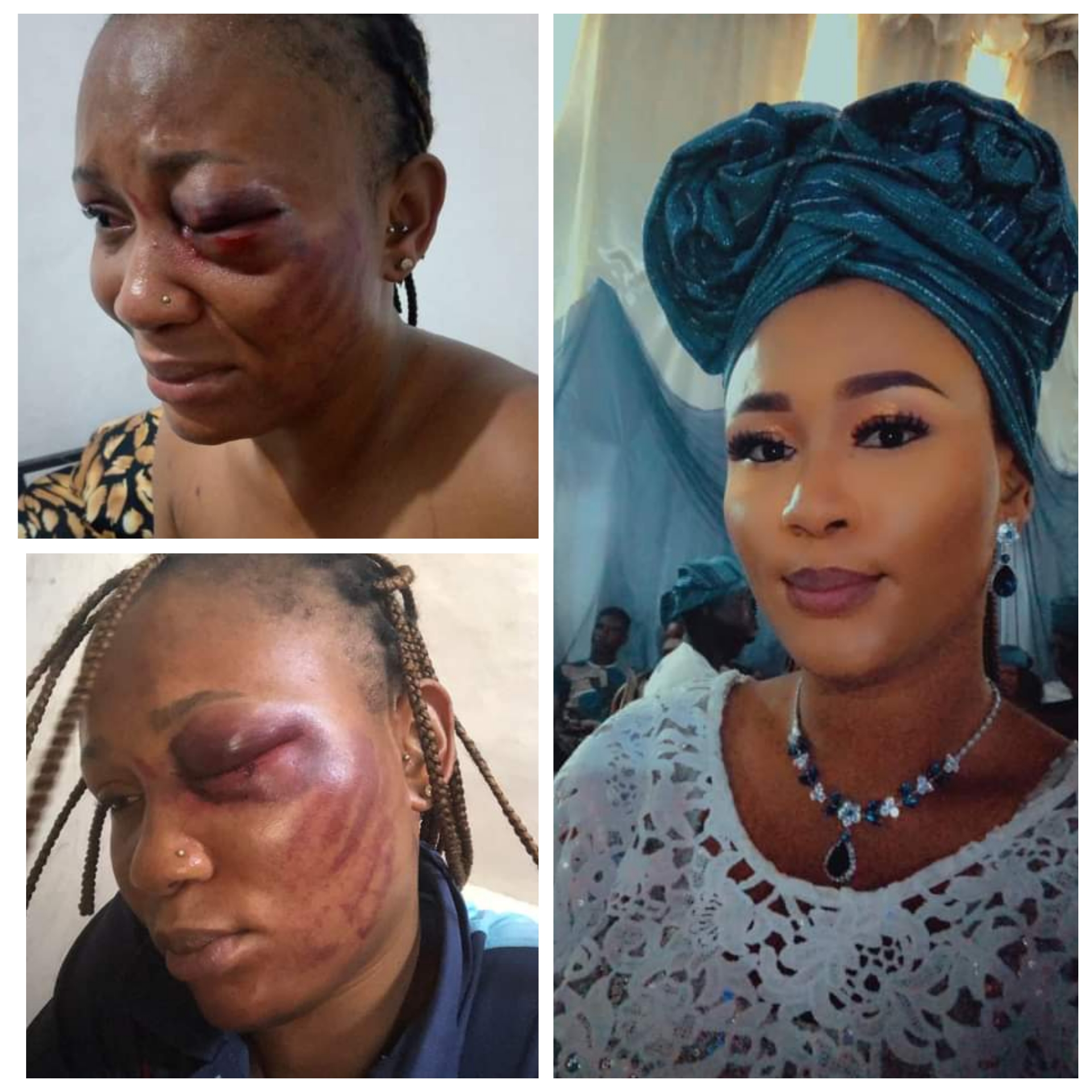 Nigerian Woman loose Her Eye